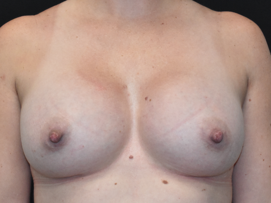 Breast Augmentation Case 3 - After