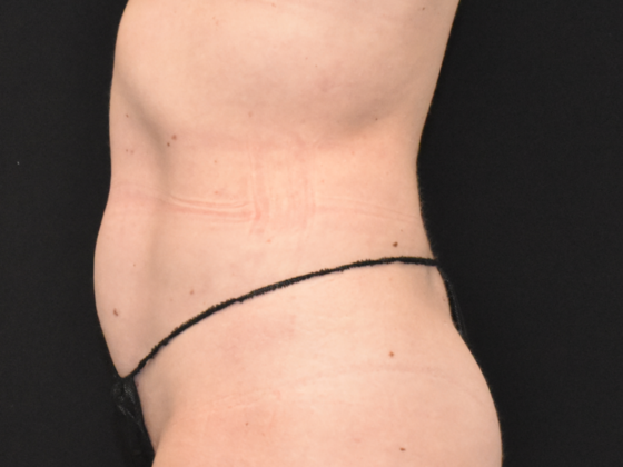 Liposuction: Case 2 - After