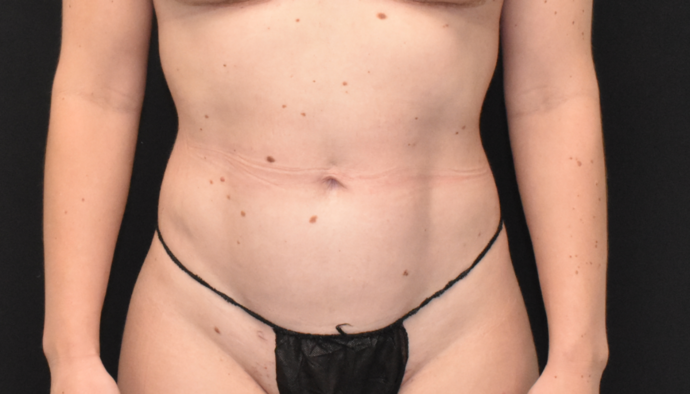 Liposuction Case 2 - After
