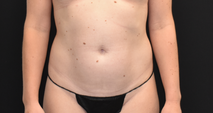 Liposuction Case 2 - Before