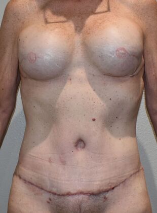 Mommy Makeover Case 292 - After