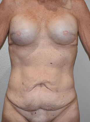 Mommy Makeover Case 292 - Before