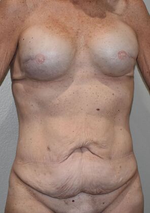 Mommy Makeover: Case 292 - Before