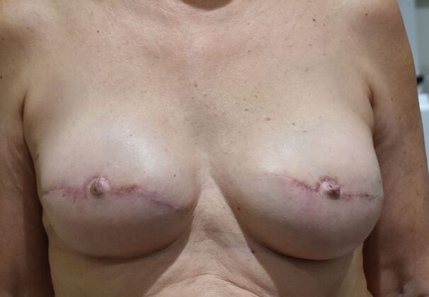 Breast Reconstruction Case 85 - After