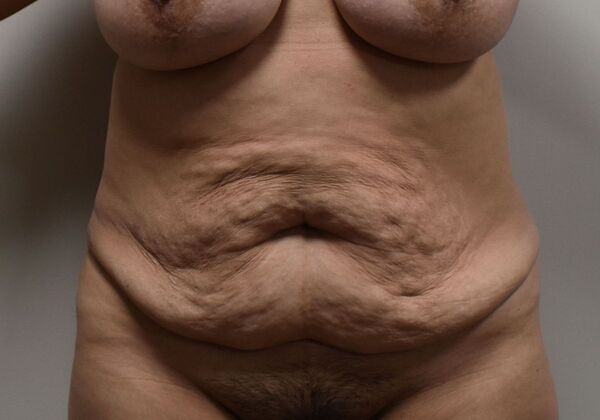 Tummy Tuck (Abdominoplasty): Case 457 - Before