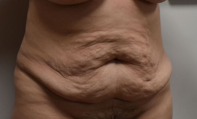 Tummy Tuck (Abdominoplasty): Case 457 - Before