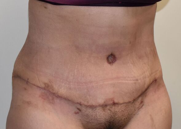 Tummy Tuck (Abdominoplasty): Case 457 - After