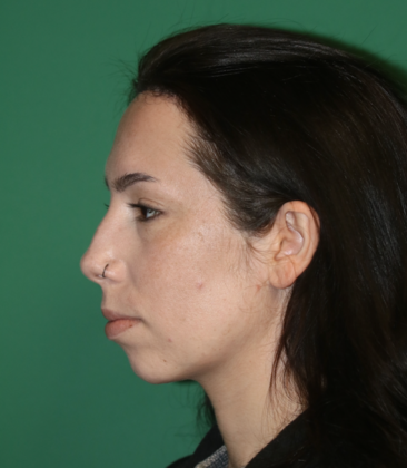Hairline Lowering Surgery Case 22 - After