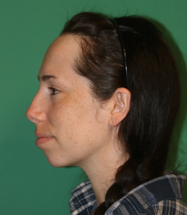 Hairline Lowering Surgery Case 22 - Before