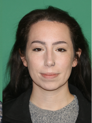 Hairline Lowering Surgery: Case 22 - After