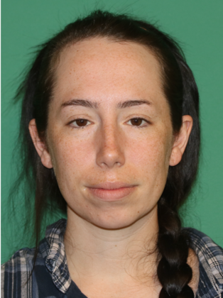 Hairline Lowering Surgery: Case 22 - Before