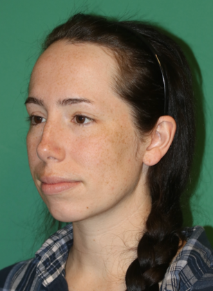 Hairline Lowering Surgery: Case 22 - Before