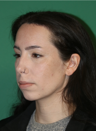 Hairline Lowering Surgery: Case 22 - After