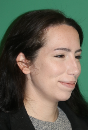 Hairline Lowering Surgery: Case 22 - After