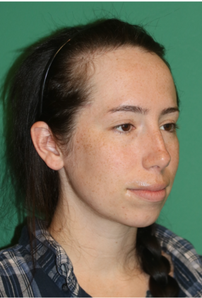 Hairline Lowering Surgery: Case 22 - Before