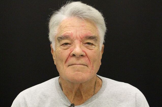 Face & Neck Lifts: Case 30 - Before