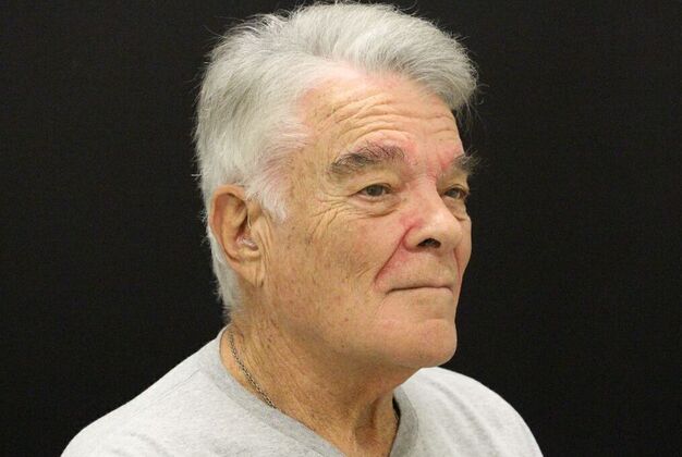 Face & Neck Lifts: Case 30 - After