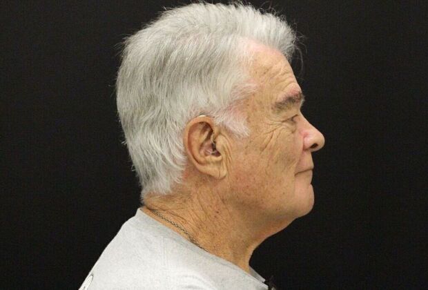 Face & Neck Lifts: Case 30 - Before