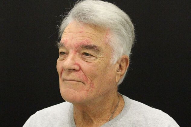 Face & Neck Lifts: Case 30 - Before