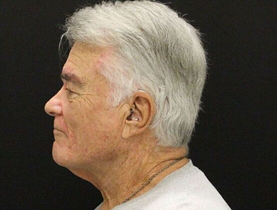 Face & Neck Lifts: Case 30 - Before