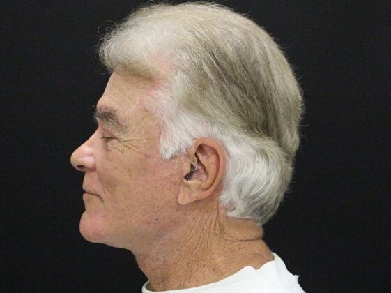 Face & Neck Lifts: Case 30 - After