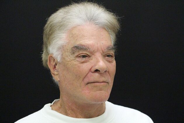 Face & Neck Lifts: Case 30 - Before