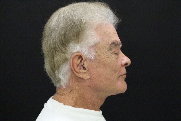 Face & Neck Lifts: Case 30 - After