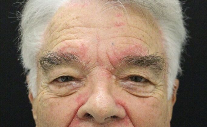 Eyelid Surgery Case 9 - Before