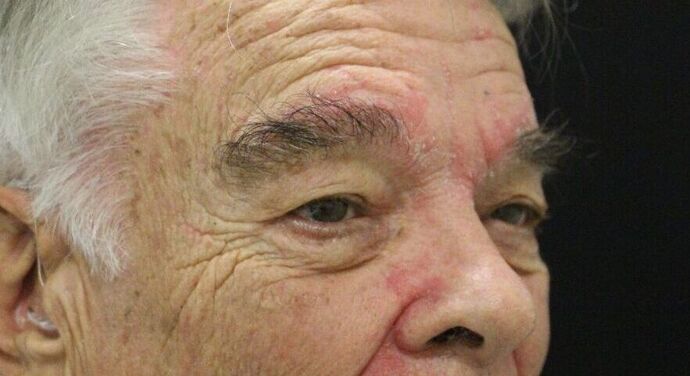 Eyelid Surgery: Case 9 - Before