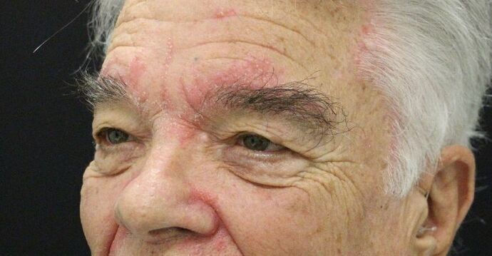 Eyelid Surgery: Case 9 - Before