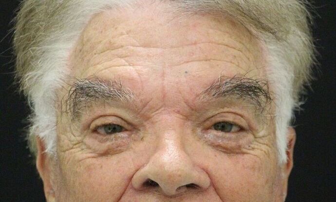 Eyelid Surgery Case 9 - After