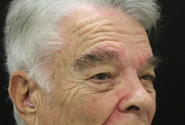 Forehead & Brow Lifts: Case 2 - Before