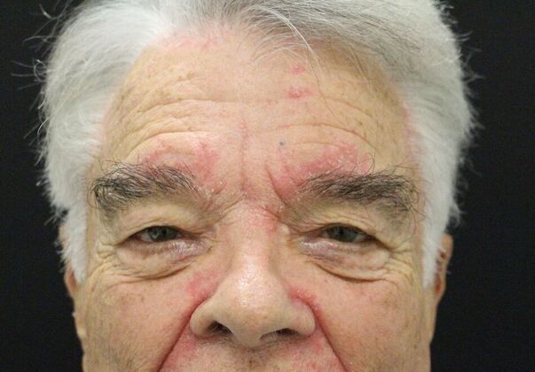 Forehead & Brow Lifts Case 2 - Before