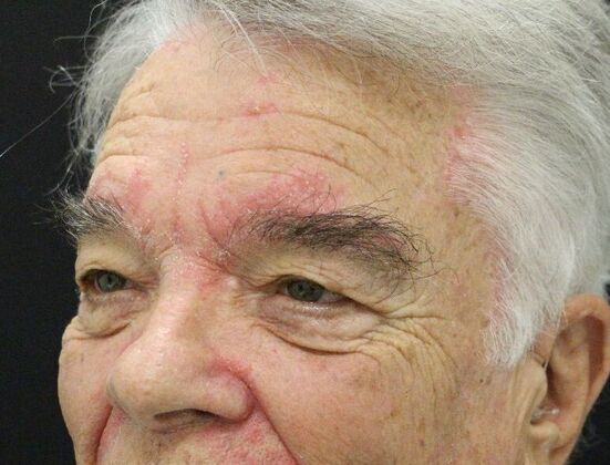 Forehead & Brow Lifts: Case 2 - Before