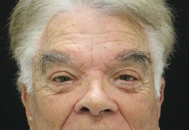 Forehead & Brow Lifts Case 2 - After