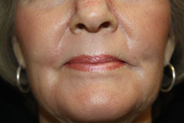 Non-Surgical: Case 1 - After