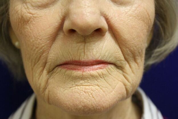 Non-Surgical: Case 1 - Before