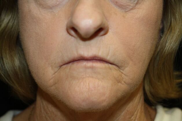 Non-Surgical: Case 3 - After