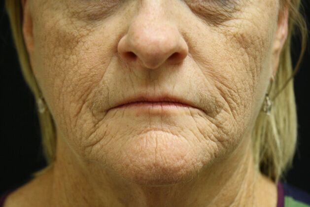 Non-Surgical: Case 3 - Before