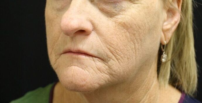 Non-Surgical: Case 3 - Before