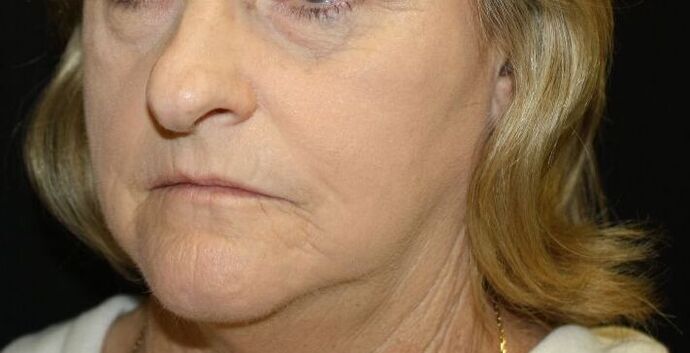 Non-Surgical: Case 3 - After