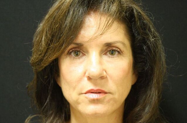 Non-Surgical: Case 4 - After