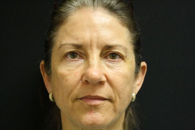 Non-Surgical: Case 4 - Before