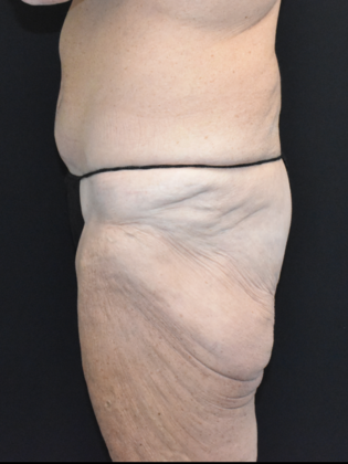 Torsoplasty: Case 1 - Before