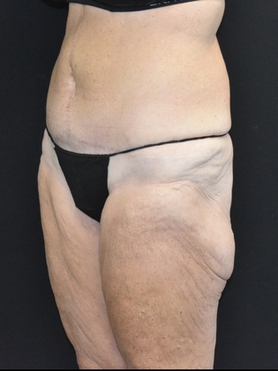 Torsoplasty: Case 1 - Before