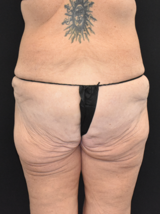 Torsoplasty: Case 1 - Before