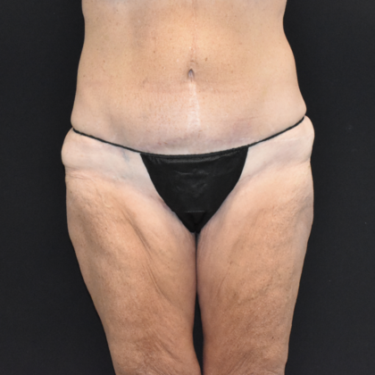 Torsoplasty: Case 1 - Before