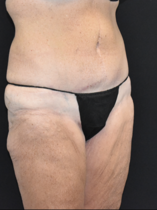 Torsoplasty: Case 1 - Before