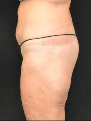 Torsoplasty: Case 1 - After