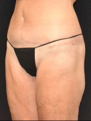 Torsoplasty: Case 1 - After